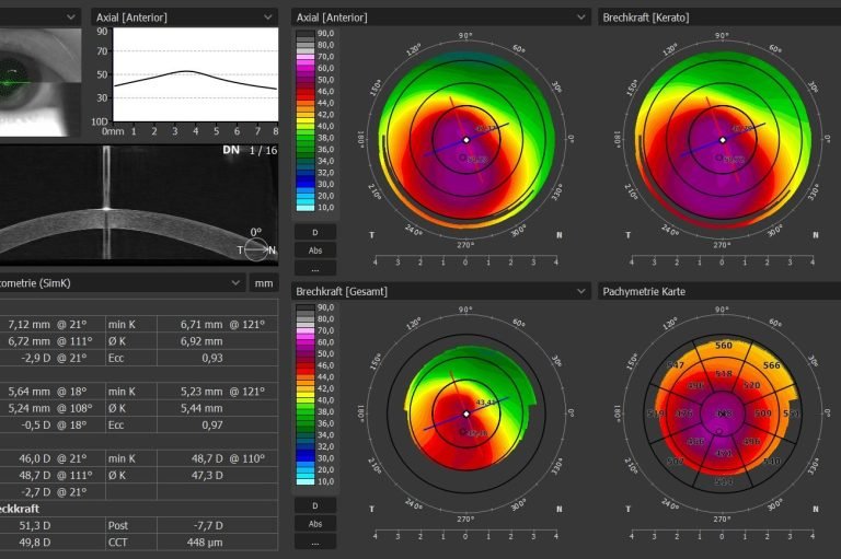 Glaukom-Laser SLT und YAG-Iridotomie
