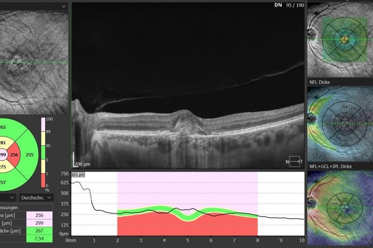 Berührungslose Augendruckmessung Tonometer
